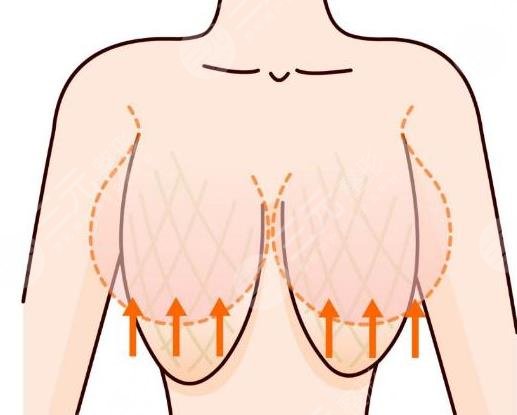 乳房提升棒棒糖手术多少钱