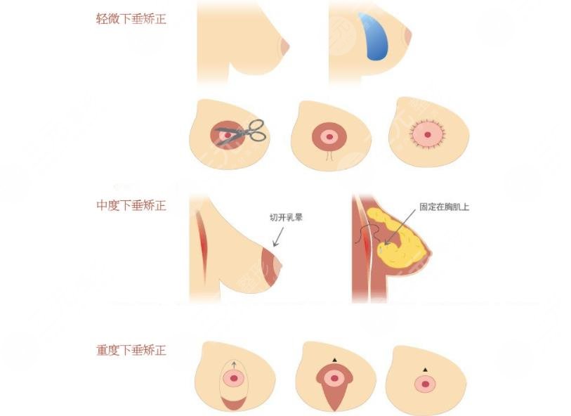 乳房提升棒棒糖手术原理