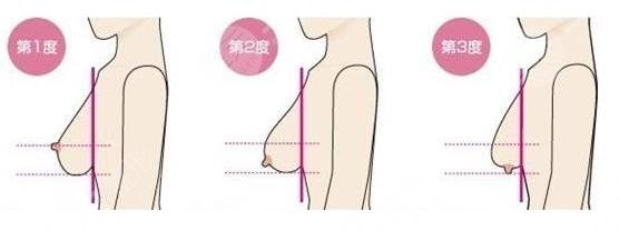 乳房提升棒棒糖术后注意事项