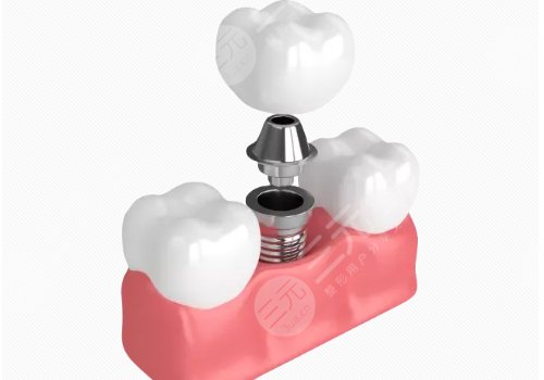 牙齿种植技术
