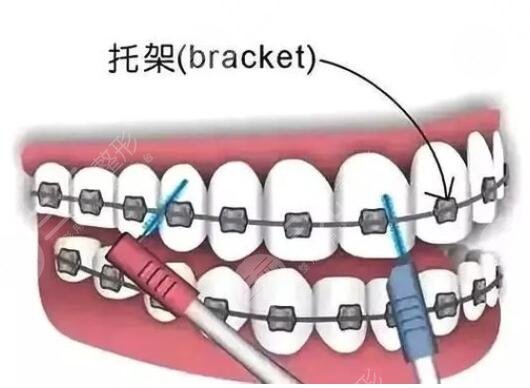 金属矫正牙齿