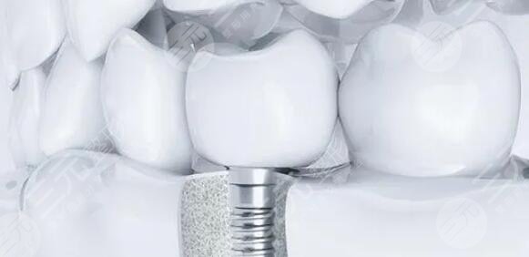 牙齿种植手术