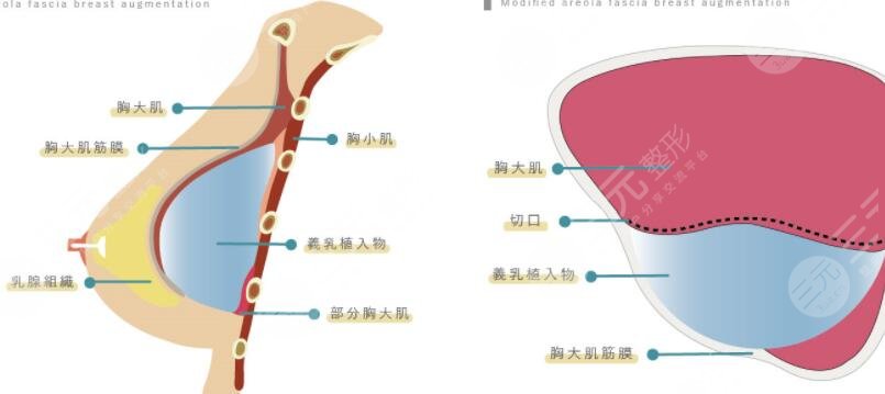 假体隆胸