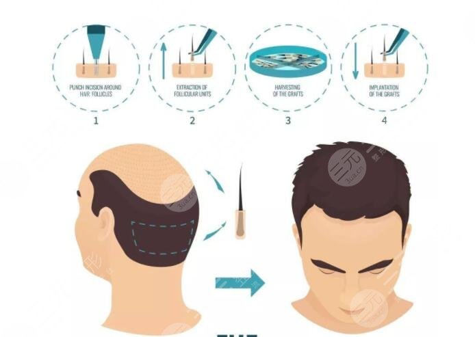 毛发种植