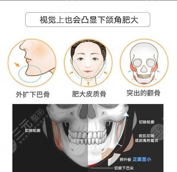 磨骨整形