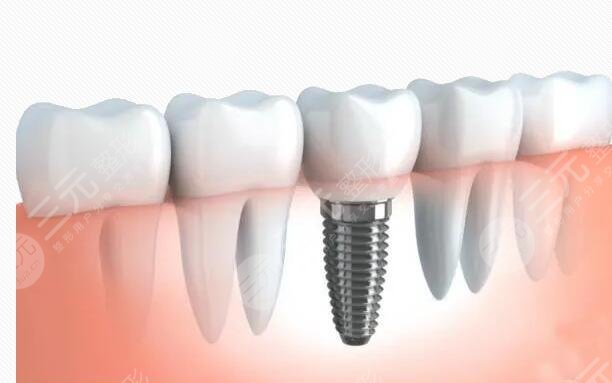 牙齿种植前要注意什么