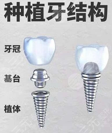牙齿种植适合哪些人群