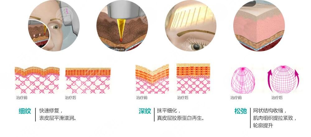 光子嫩肤有哪些功?