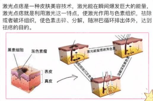 激光去痣大概多少钱一颗?2025价格参考表+术后护理技巧盘点