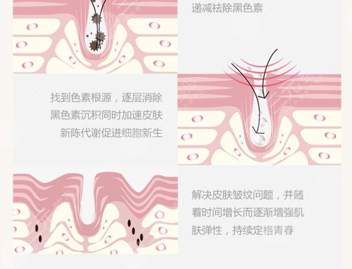 点阵激光