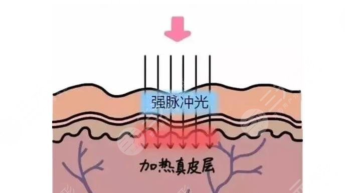 光子嫩肤有哪些优点?