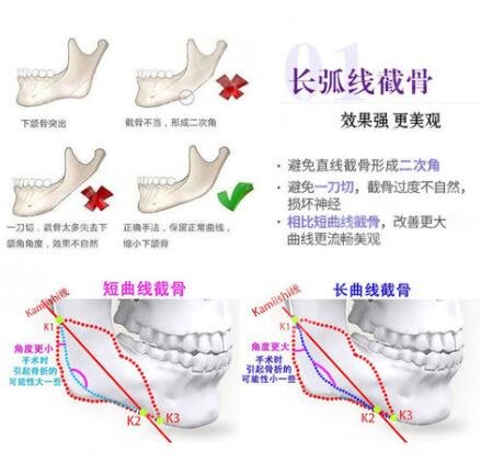 磨骨手术