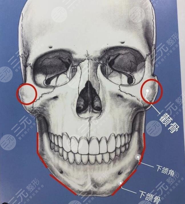 磨颧骨手术能改脸型吗