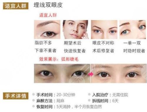 埋线双眼皮有哪些优点和缺点
