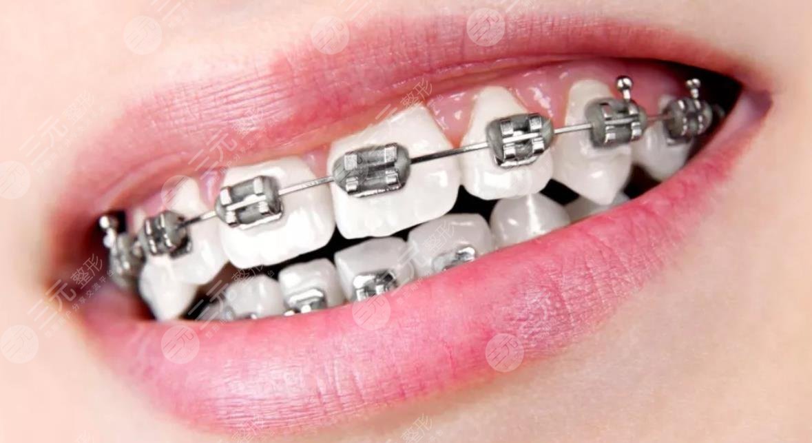 传统金属托槽矫正