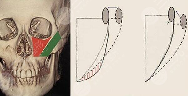 磨骨手术的原理