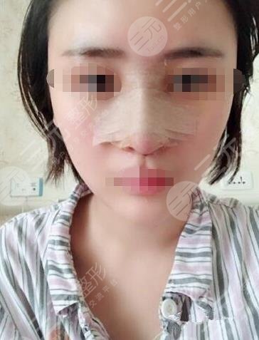 哈尔滨211美容科隆鼻手术过程分享