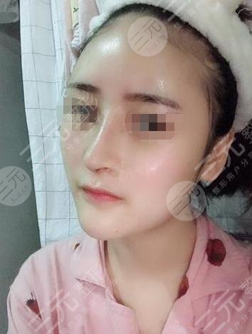 哈尔滨211美容科隆鼻手术过程分享