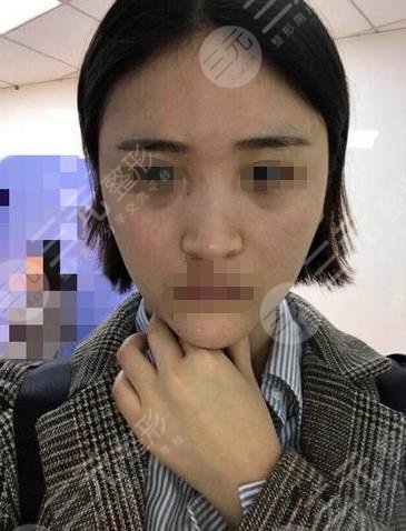 哈尔滨211美容科隆鼻手术过程分享
