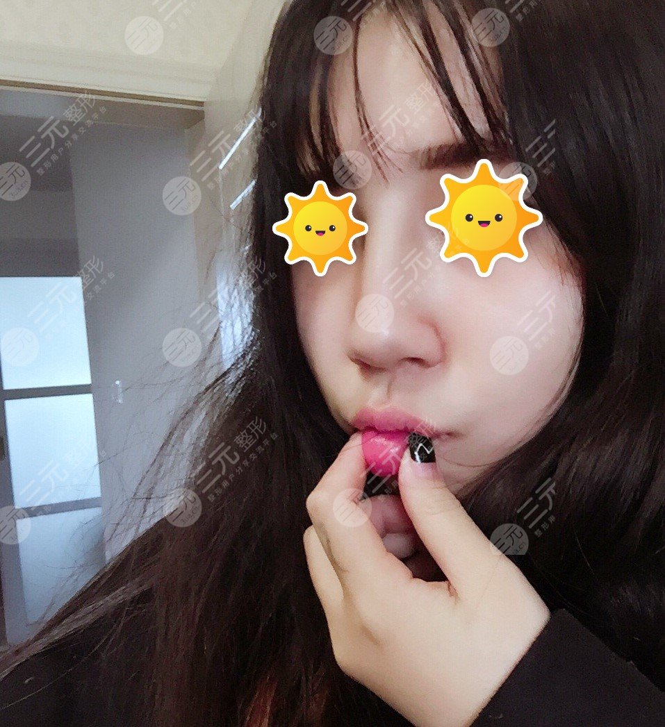 兰大二院整形外科隆鼻案例