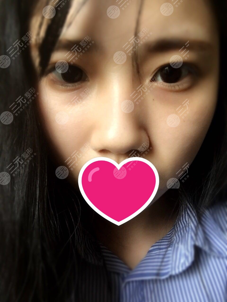 兰大二院整形外科隆鼻案例