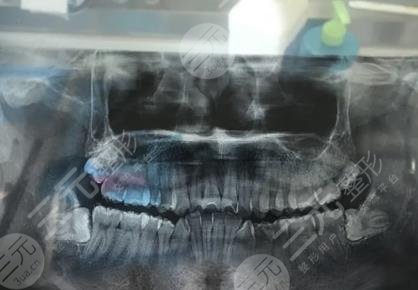 厦门口腔医院拔智齿经历分享