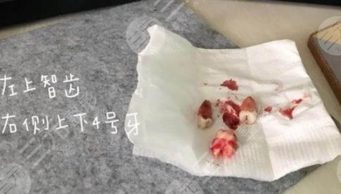 厦门口腔医院拔智齿经历分享