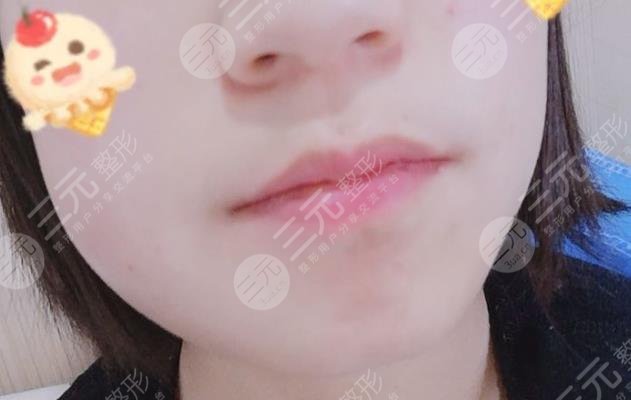 厦门口腔医院拔智齿经历分享