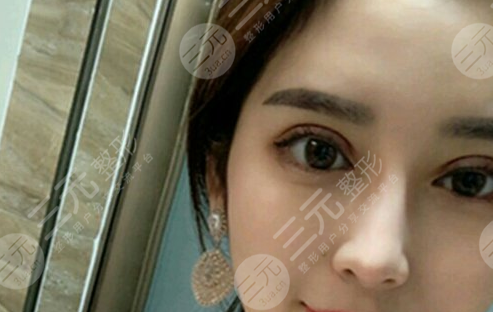 靳小雷双眼皮修复案例