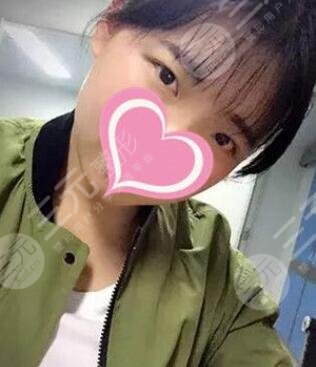 厦门第一医院整形科双眼皮前