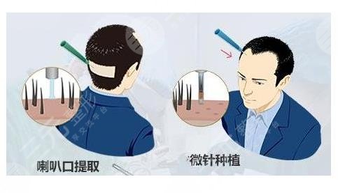 成都艺美汇植发费用贵不贵