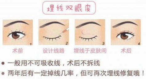 埋线法做双眼皮价格是多少?影响因素