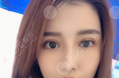 靳小雷双眼皮修复案例