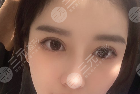 靳小雷双眼皮修复案例