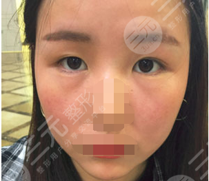 九院苏薇洁双眼皮价格