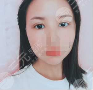 九院苏薇洁双眼皮价格