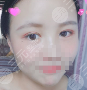 九院苏薇洁双眼皮价格