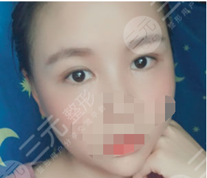 九院苏薇洁双眼皮价格