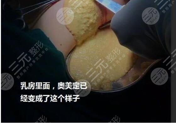 取奥美定一个部位多少钱