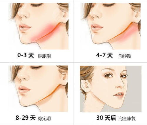重庆下颌角手术费用