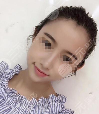fotonna 4d术后