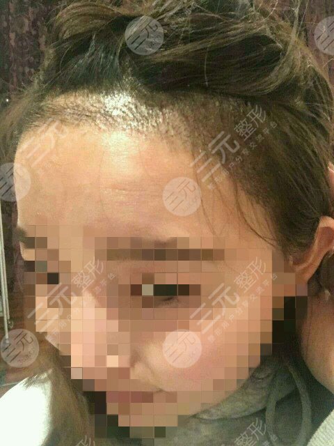 亲身植发经历