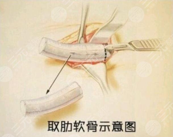 做肋骨隆鼻价格一般多少钱？这些原因都在影响隆鼻价格，你知道吗？