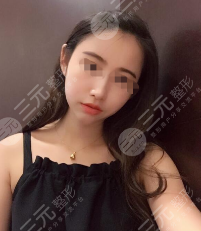 fotonna 4d术后3个月