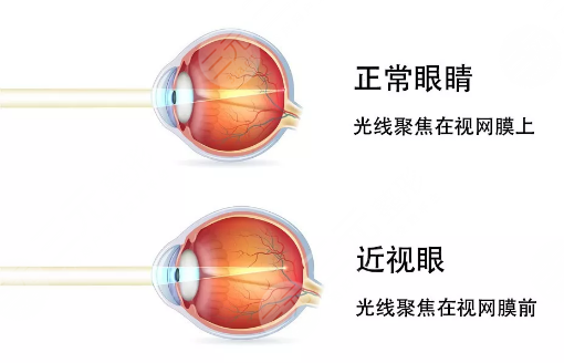 成都近视眼手术费用多少钱？2023价格表参考！视力矫正必看！