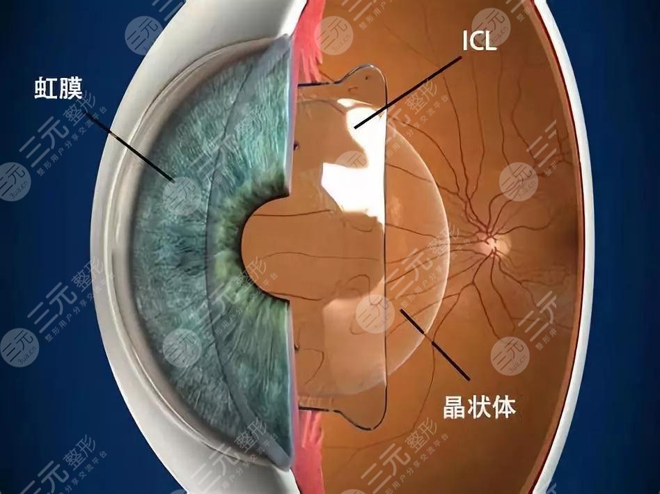 成都近视眼手术费用多少