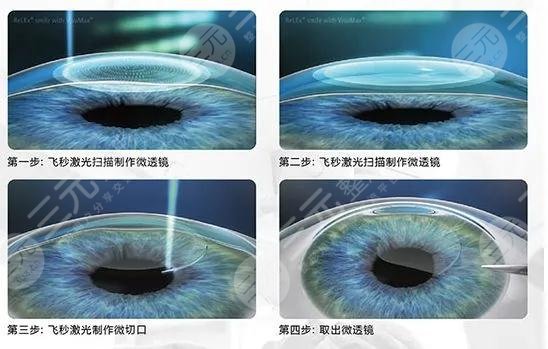 上海近视矫正手术的价格是多少？2023年参考价公布！