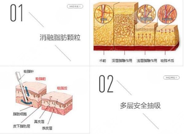 超脂塑溶脂要多少钱