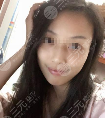 上海葛志鑫隆鼻前