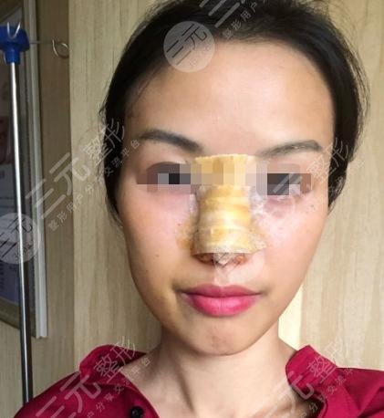 上海葛志鑫隆鼻后一周